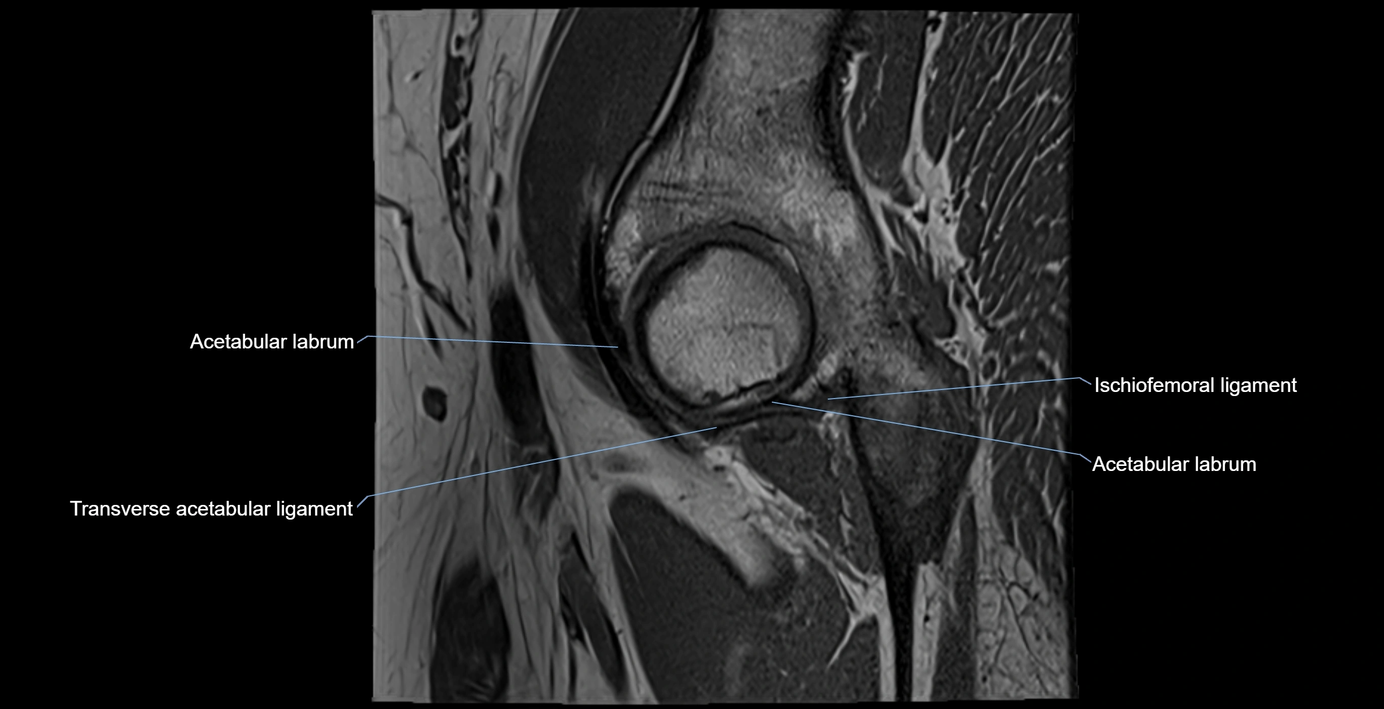 MRI Hip ligaments sagittal cross sectional anatomy 3T  radiology  image-img-00001-00006.webp